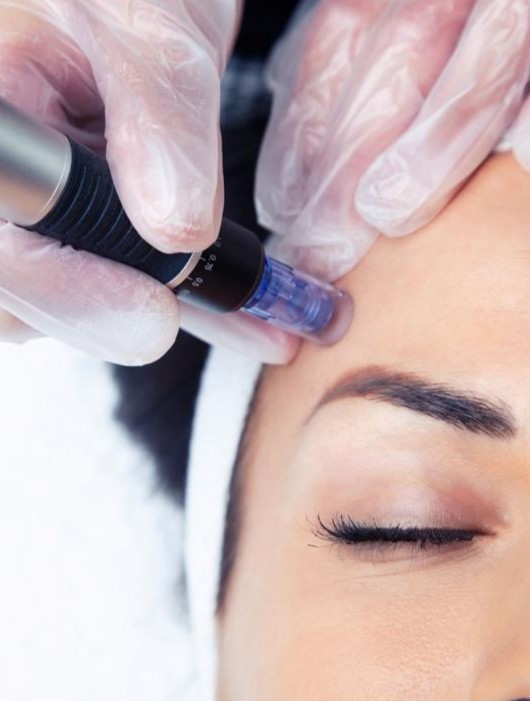 Exosome Microneedling Infusion